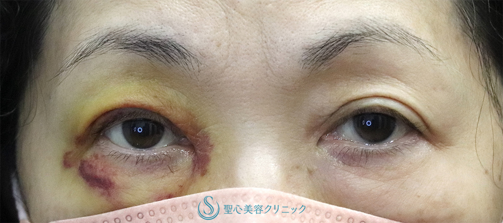 【60代女性・右目の下垂】眼瞼下垂（腱膜縫縮法）（1ヶ月後）　 Before 