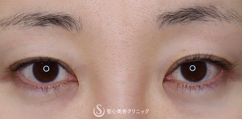 【30代女性・目を大きくパッチリに！！そして平行型に！！】眼瞼下垂（切開法/腱膜縫縮法）+目上切開（1年後） Before 