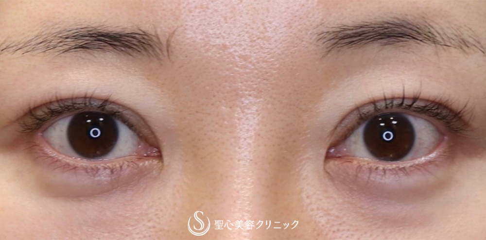 【30代女性・目を大きくパッチリに！！そして平行型に！！】眼瞼下垂（切開法/腱膜縫縮法）+目上切開（1年後） After 