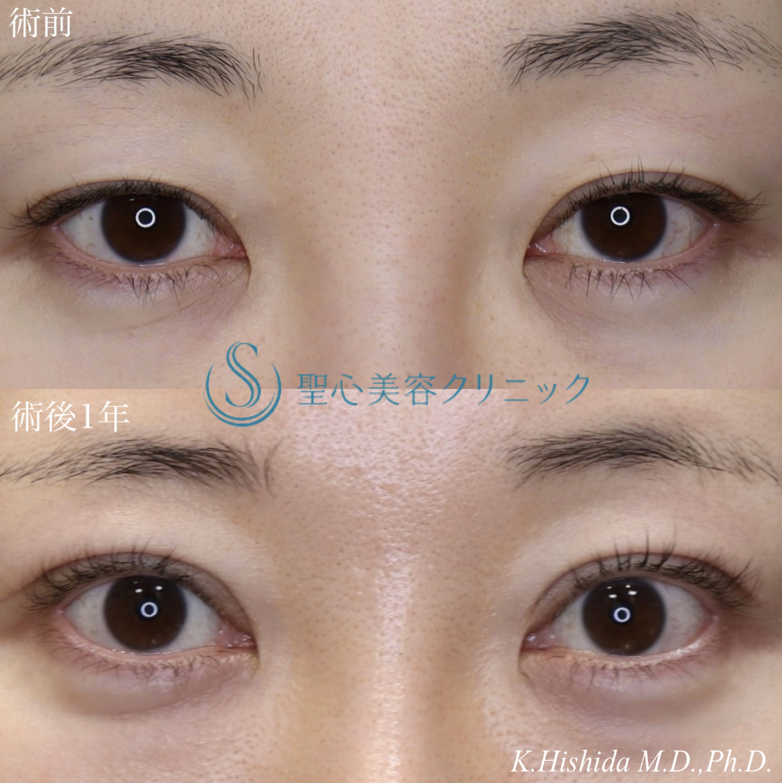 【30代女性・目を大きくパッチリに！！そして平行型に！！】眼瞼下垂（切開法/腱膜縫縮法）+目上切開（1年後） After 