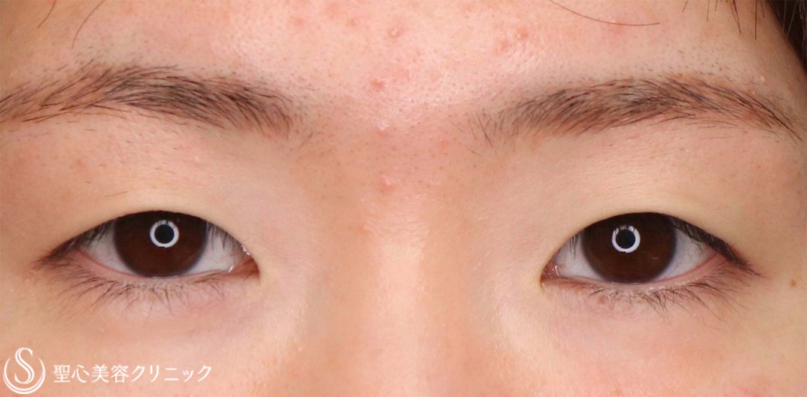 【20代女性・目の上をナチュラルにスッキリ！！】眉下リフト（眉下切開法）（術後6ヶ月） Before 