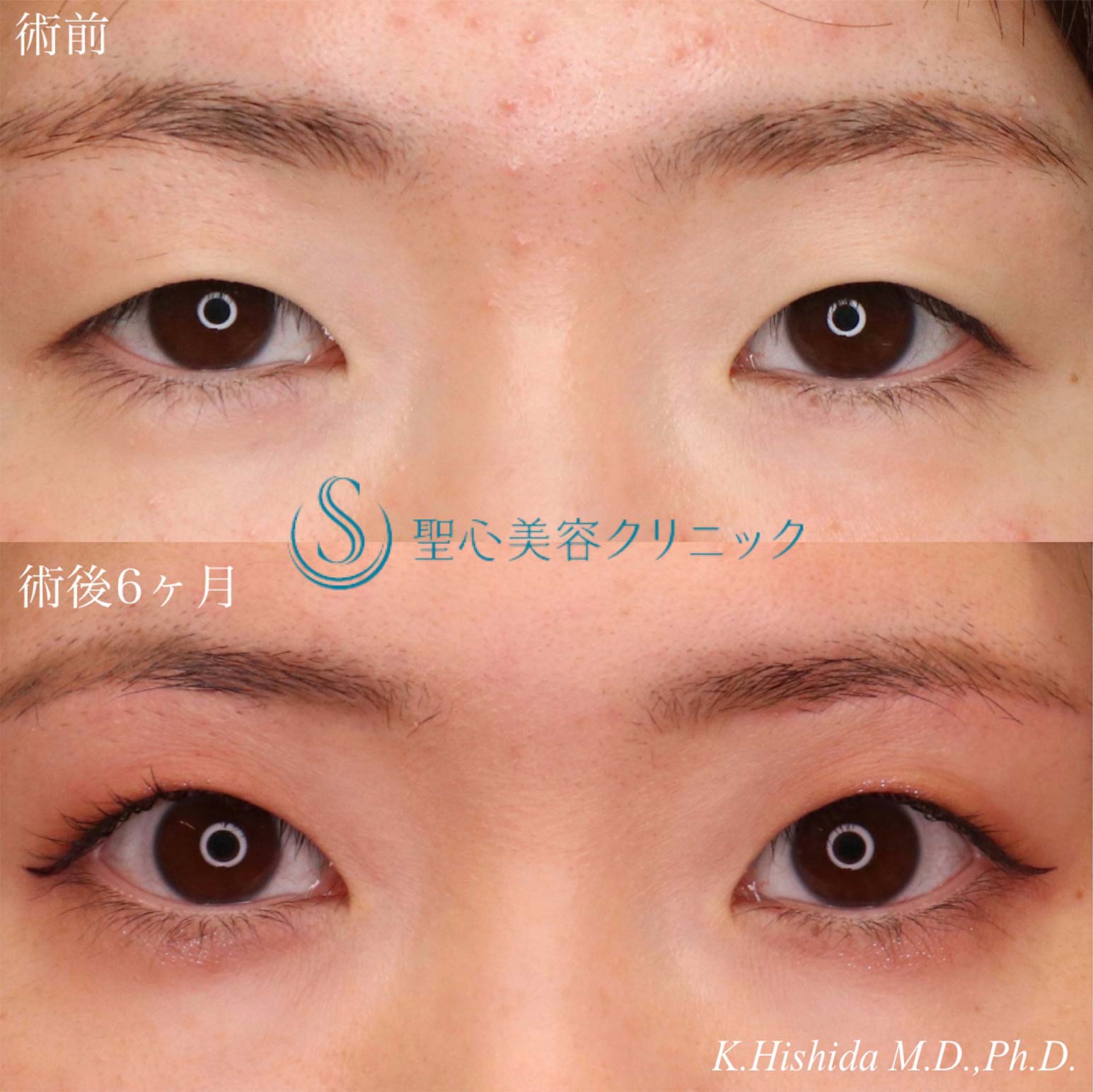 【20代女性・目の上をナチュラルにスッキリ！！】眉下リフト（眉下切開法）（術後6ヶ月） After 