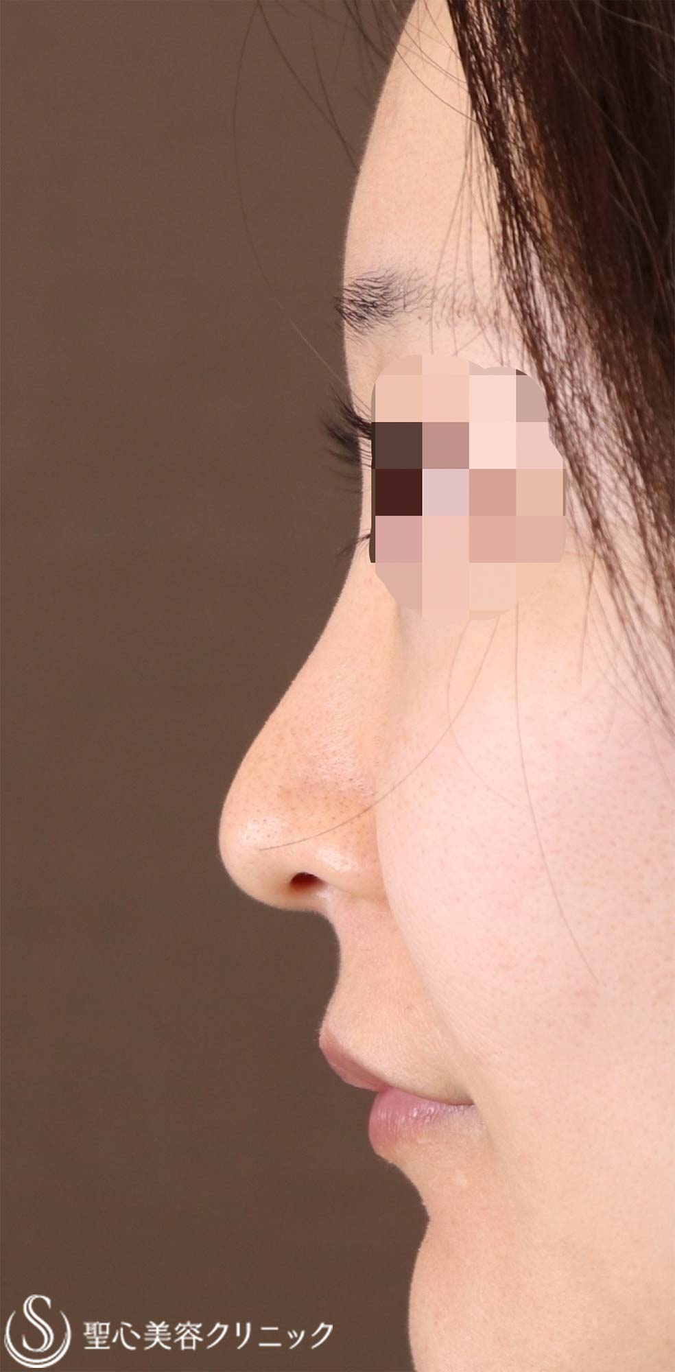 【40代女性・周りにバレない程度で鼻をナチュラルにバランス良くスッキリ！！】プロテーゼ＋鼻尖縮小＋鼻尖形成（耳介軟骨移植・ストラット法）（術後6ヶ月） Before 