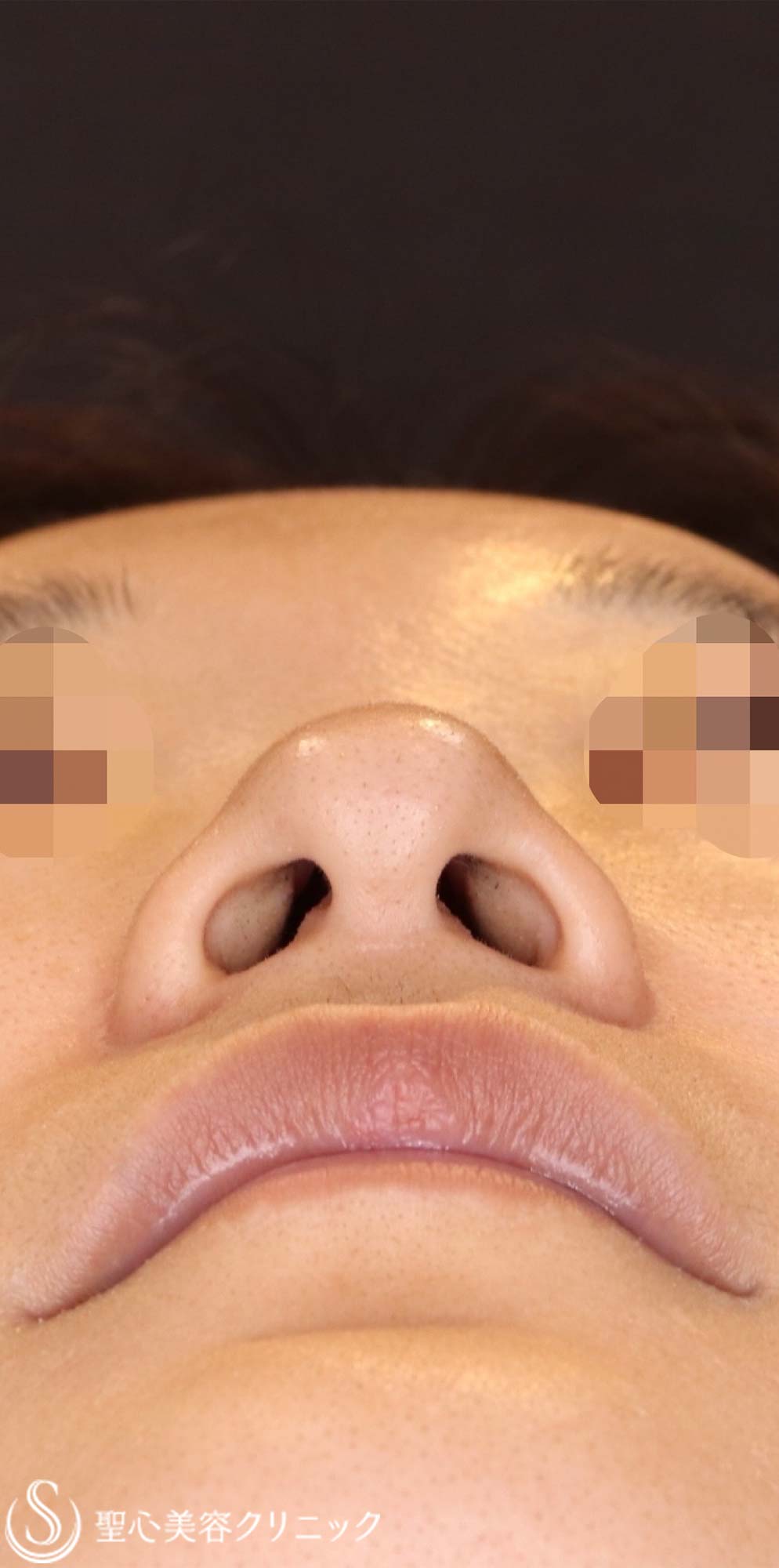 【40代女性・周りにバレない程度で鼻をナチュラルにバランス良くスッキリ！！】プロテーゼ＋鼻尖縮小＋鼻尖形成（耳介軟骨移植・ストラット法）（術後6ヶ月） Before 