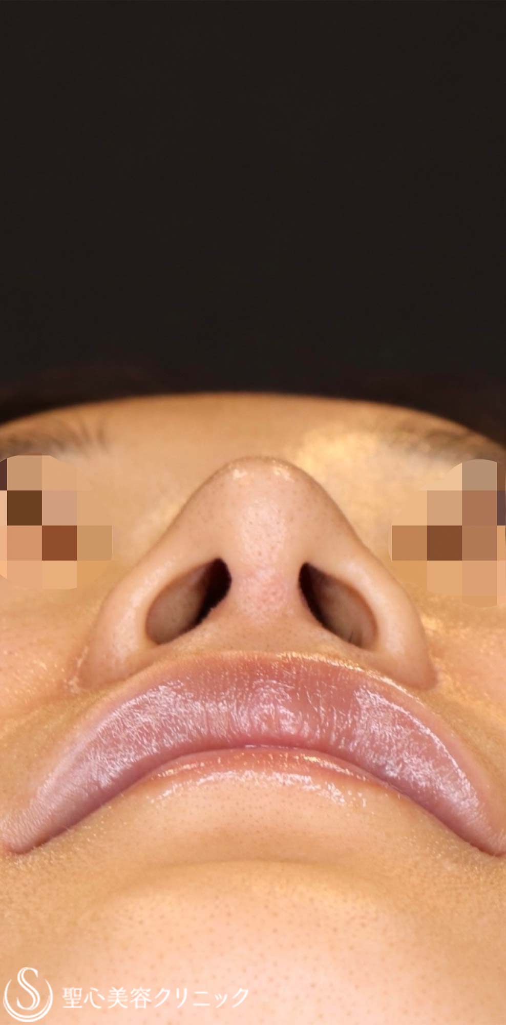 【40代女性・周りにバレない程度で鼻をナチュラルにバランス良くスッキリ！！】プロテーゼ＋鼻尖縮小＋鼻尖形成（耳介軟骨移植・ストラット法）（術後6ヶ月） After 