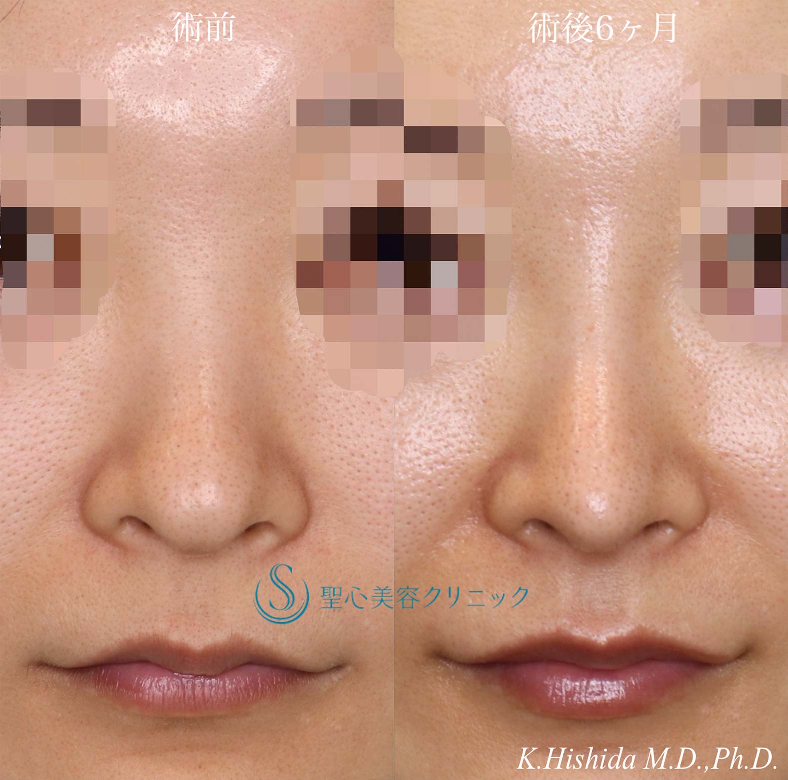 【40代女性・周りにバレない程度で鼻をナチュラルにバランス良くスッキリ！！】プロテーゼ＋鼻尖縮小＋鼻尖形成（耳介軟骨移植・ストラット法）（術後6ヶ月） After 