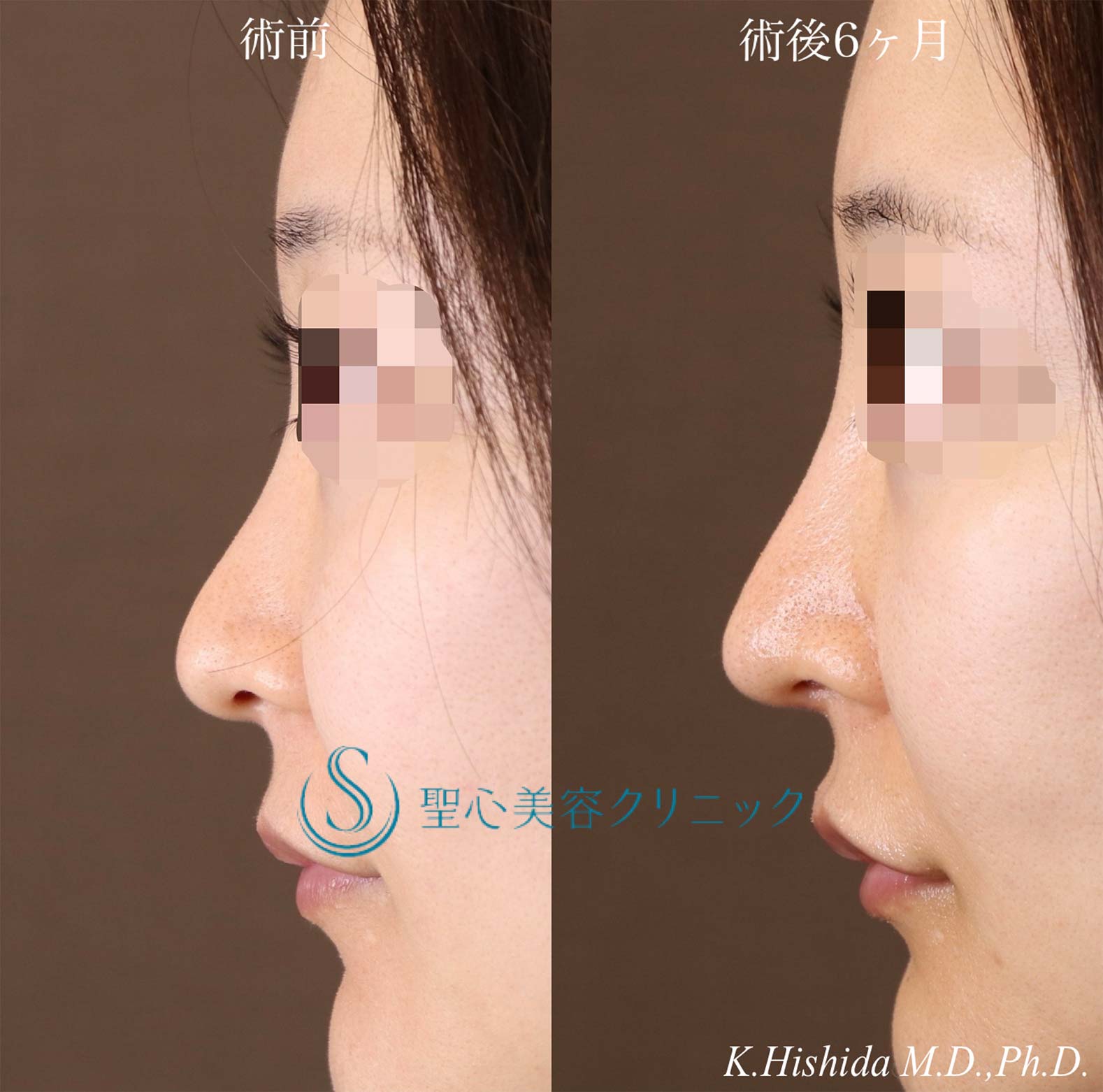 【40代女性・周りにバレない程度で鼻をナチュラルにバランス良くスッキリ！！】プロテーゼ＋鼻尖縮小＋鼻尖形成（耳介軟骨移植・ストラット法）（術後6ヶ月） After 