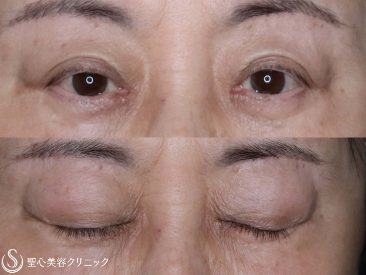 【60代女性・末広二重を平行二重に】目上切開（術後2か月） Before 