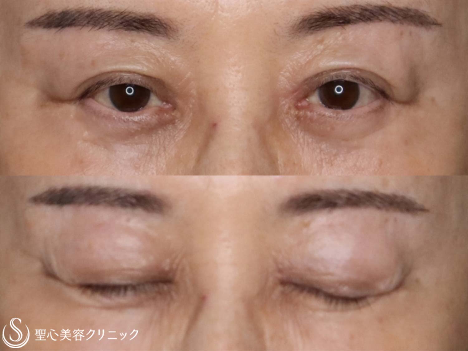 【60代女性・末広二重を平行二重に】目上切開（術後2か月） After 