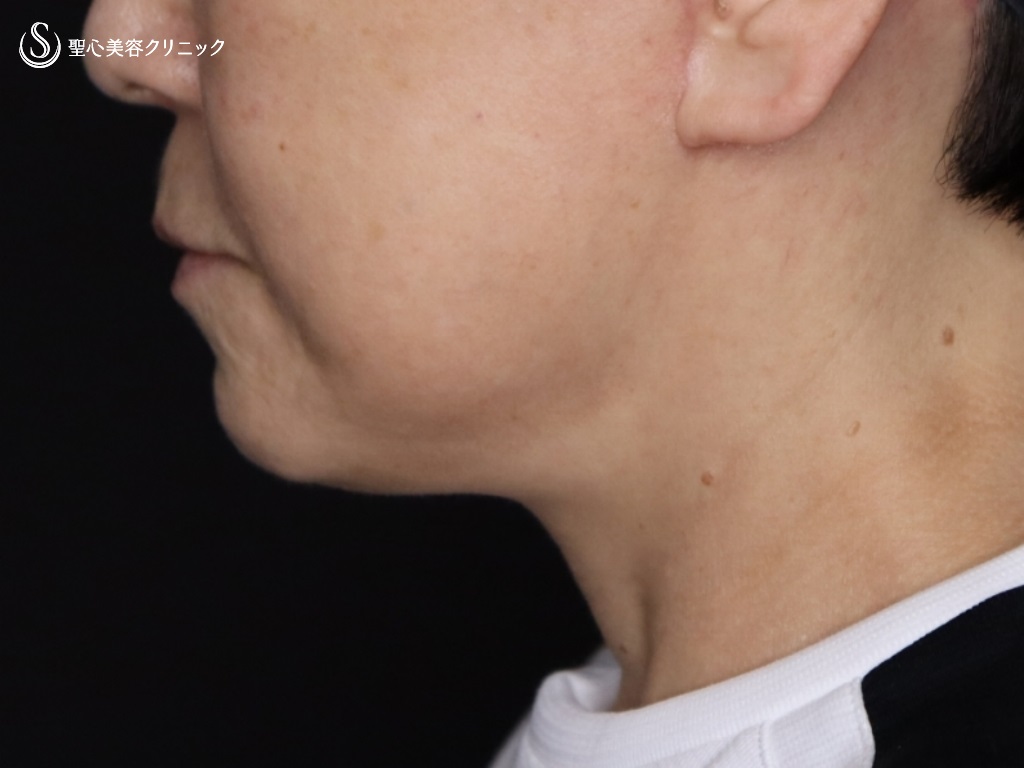 【60代女性・頬～フェイスライン～顎下～首のたるみ】プレミアムミニリフト＋ネックリフト（頬～フェイスライン～首のリフトアップ）（2か月後） After 