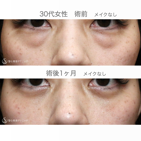 【30代女性・目の下のクマ】経結膜下脱脂術 単独（１ヶ月後） After 