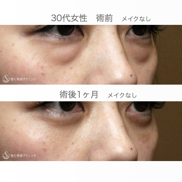 【30代女性・目の下のクマ】経結膜下脱脂術 単独（１ヶ月後） After 