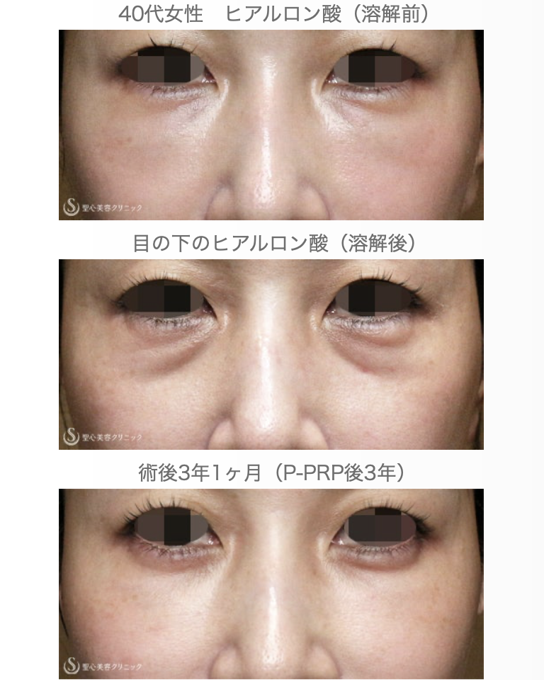 【40代女性・目の下ヒアルロン酸を溶かす】経結膜下脱脂術→プレミアムPRP皮膚再生療法（3年後） After 