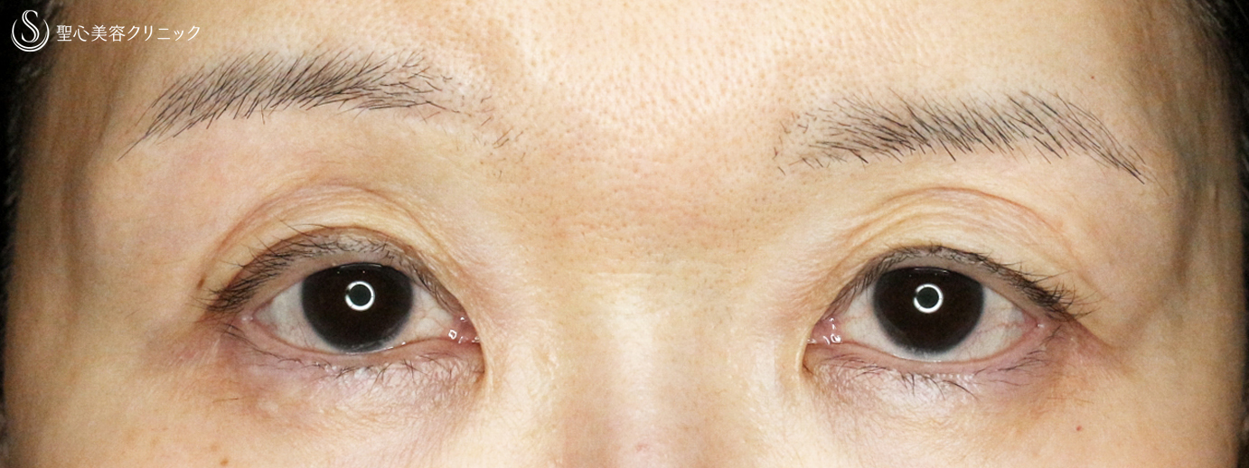 【60代女性・コンタクトレンズによる下垂】切らない眼瞼下垂+α法（7年後） After 