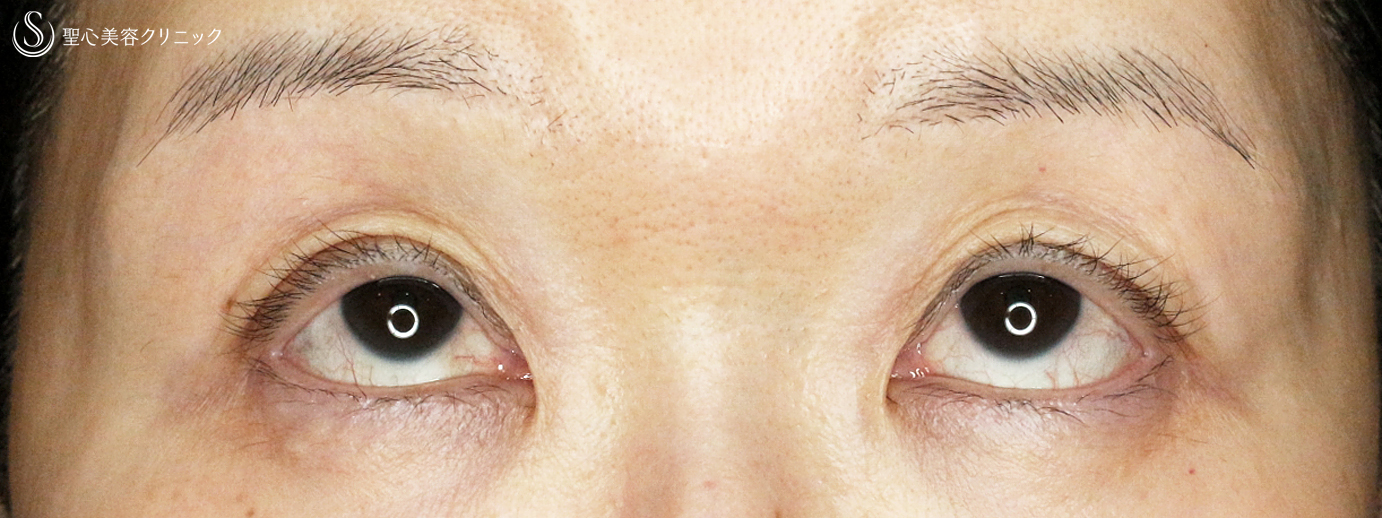 【60代女性・コンタクトレンズによる下垂】切らない眼瞼下垂+α法（7年後） After 