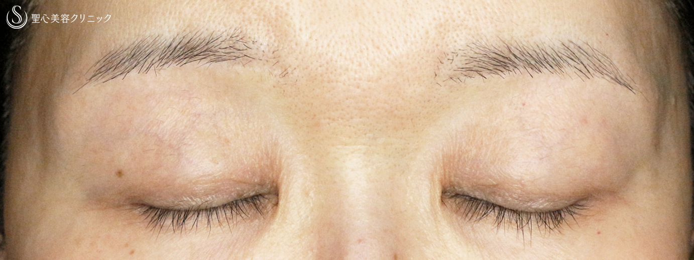 【60代女性・コンタクトレンズによる下垂】切らない眼瞼下垂+α法（7年後） After 