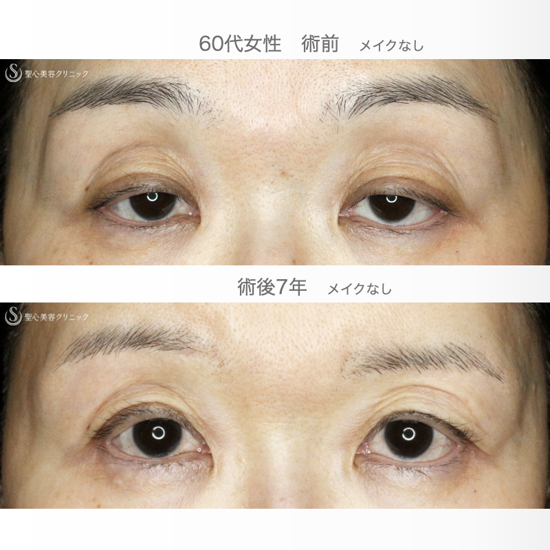 【60代女性・コンタクトレンズによる下垂】切らない眼瞼下垂+α法（7年後） After 