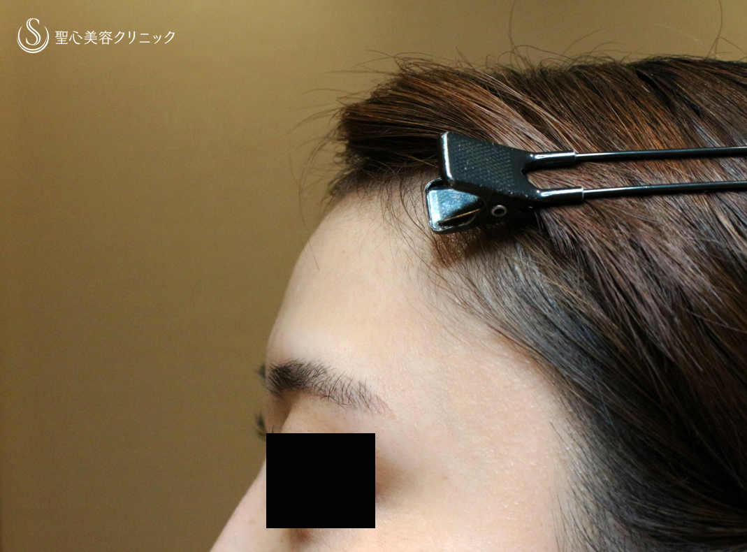 【20代女性・私が顔面に脂肪注入をしない理由】プレミアムPRP皮膚再生療法（直後〜1ヶ月後） Before 
