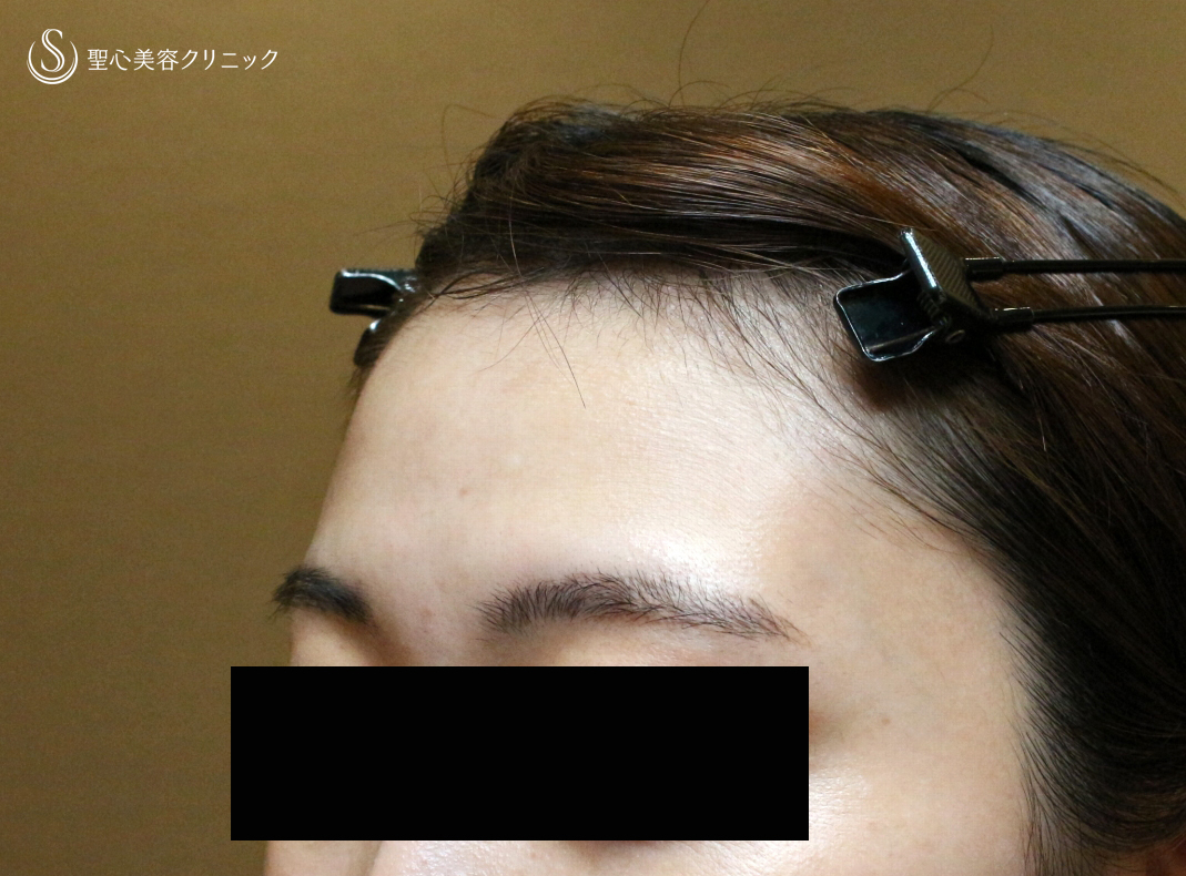 【20代女性・私が顔面に脂肪注入をしない理由】プレミアムPRP皮膚再生療法（直後〜1ヶ月後） Before 