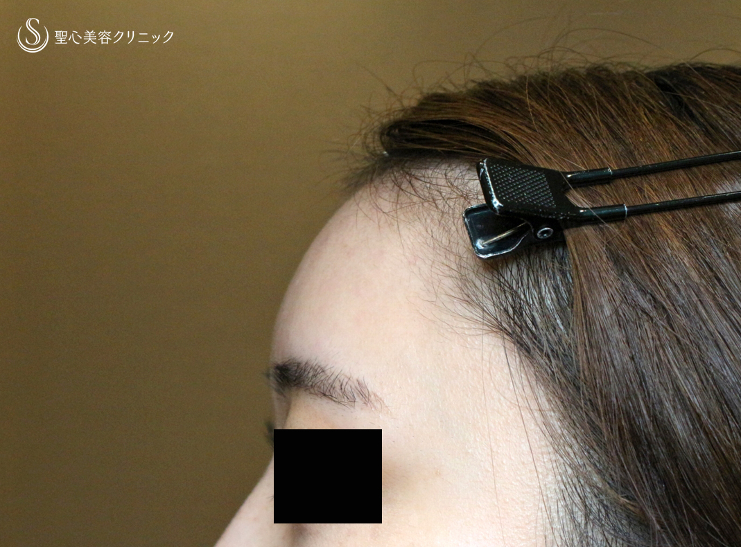 【20代女性・私が顔面に脂肪注入をしない理由】プレミアムPRP皮膚再生療法（直後〜1ヶ月後） Before 