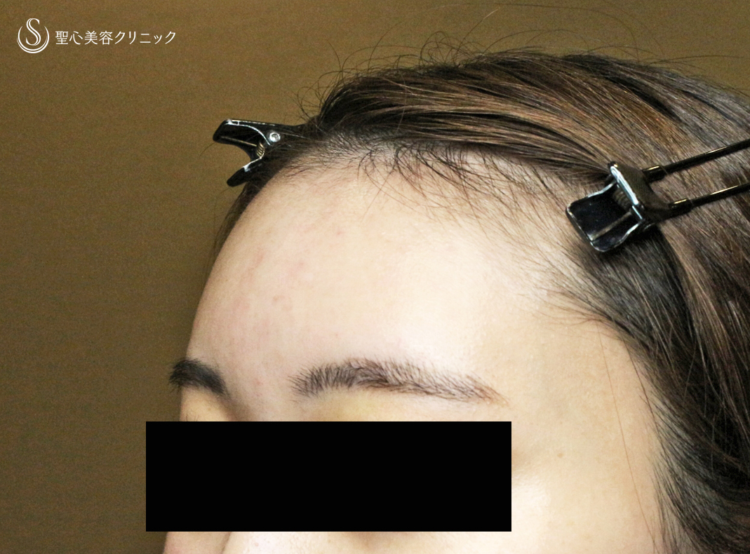 【20代女性・私が顔面に脂肪注入をしない理由】プレミアムPRP皮膚再生療法（直後〜1ヶ月後） Before 