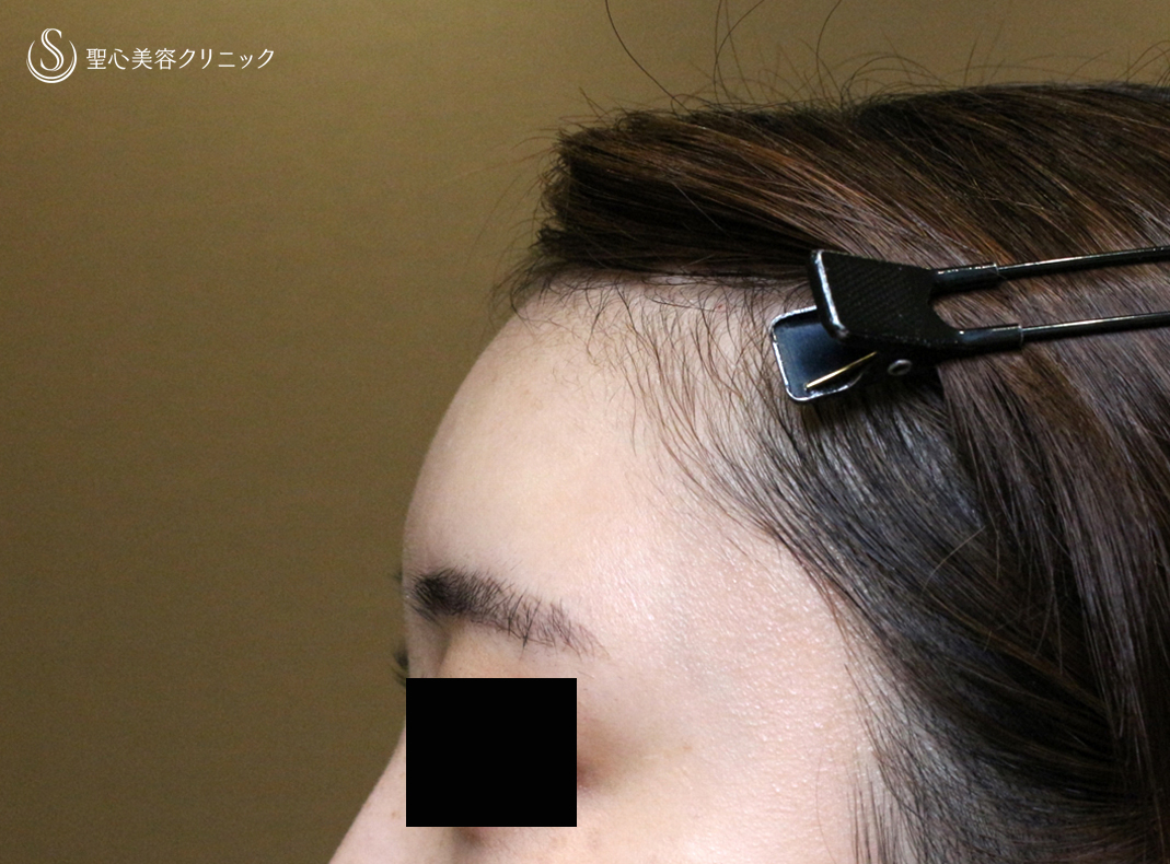 【20代女性・私が顔面に脂肪注入をしない理由】プレミアムPRP皮膚再生療法（直後〜1ヶ月後） After 