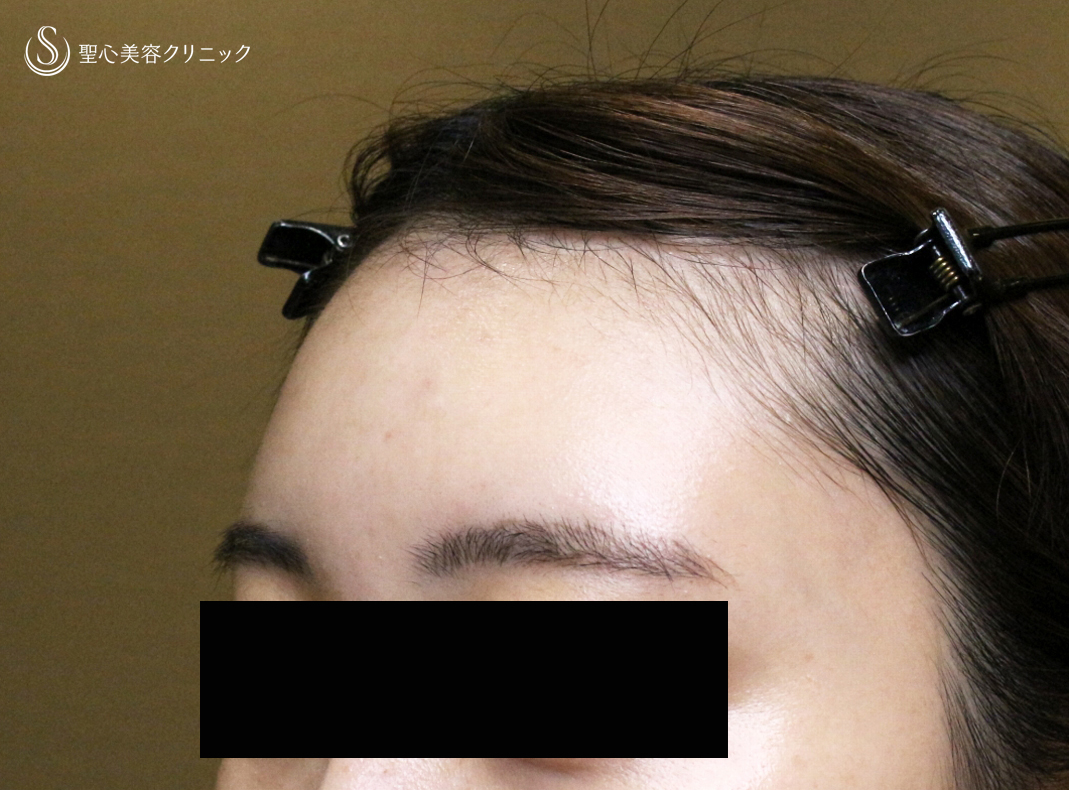 【20代女性・私が顔面に脂肪注入をしない理由】プレミアムPRP皮膚再生療法（直後〜1ヶ月後） After 