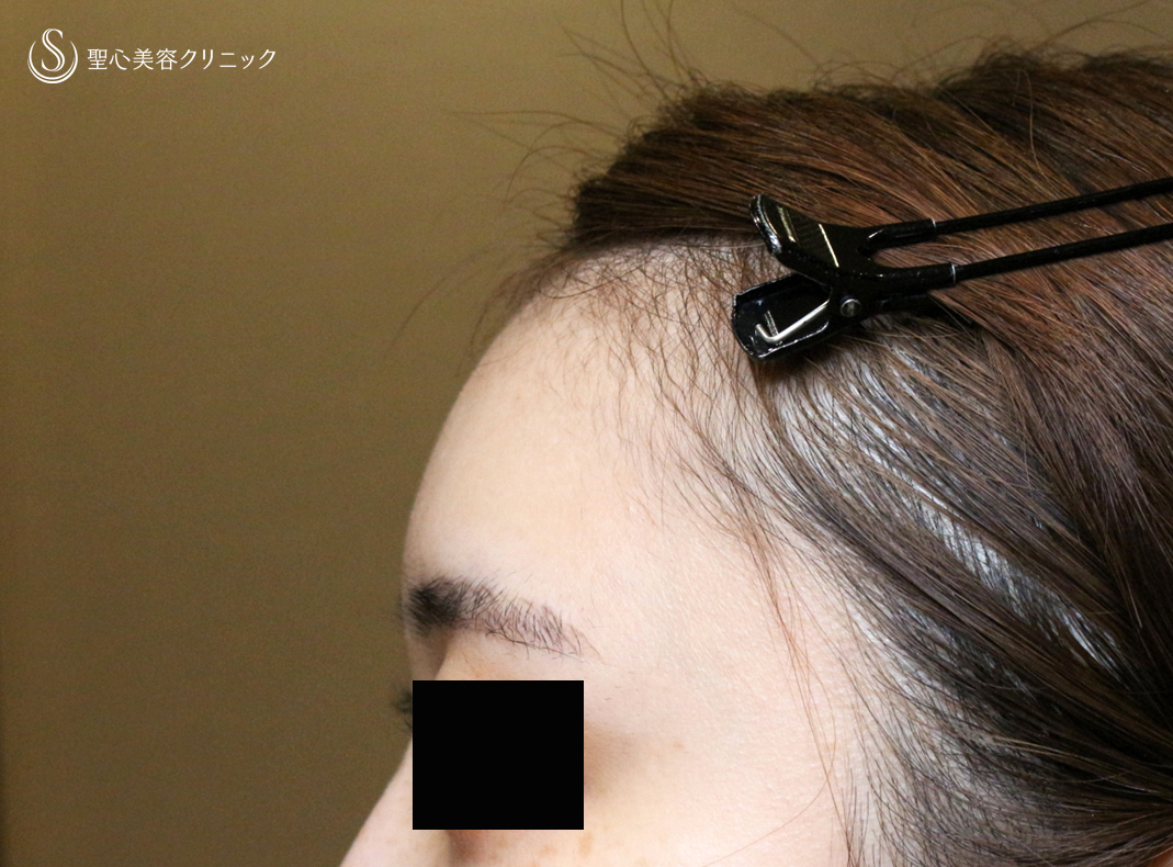 【20代女性・私が顔面に脂肪注入をしない理由】プレミアムPRP皮膚再生療法（直後〜1ヶ月後） After 