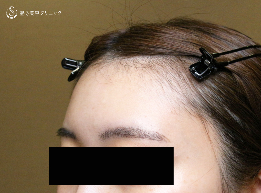 【20代女性・私が顔面に脂肪注入をしない理由】プレミアムPRP皮膚再生療法（直後〜1ヶ月後） After 
