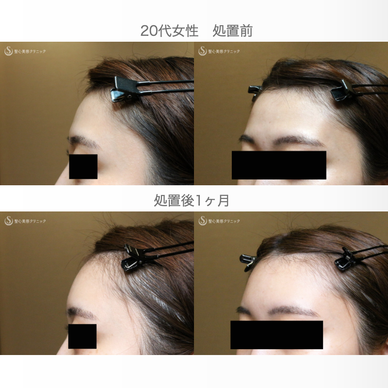 【20代女性・私が顔面に脂肪注入をしない理由】プレミアムPRP皮膚再生療法（直後〜1ヶ月後） After 