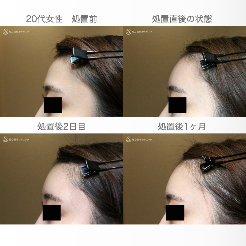 【20代女性・私が顔面に脂肪注入をしない理由】プレミアムPRP皮膚再生療法（直後〜1ヶ月後） Before 