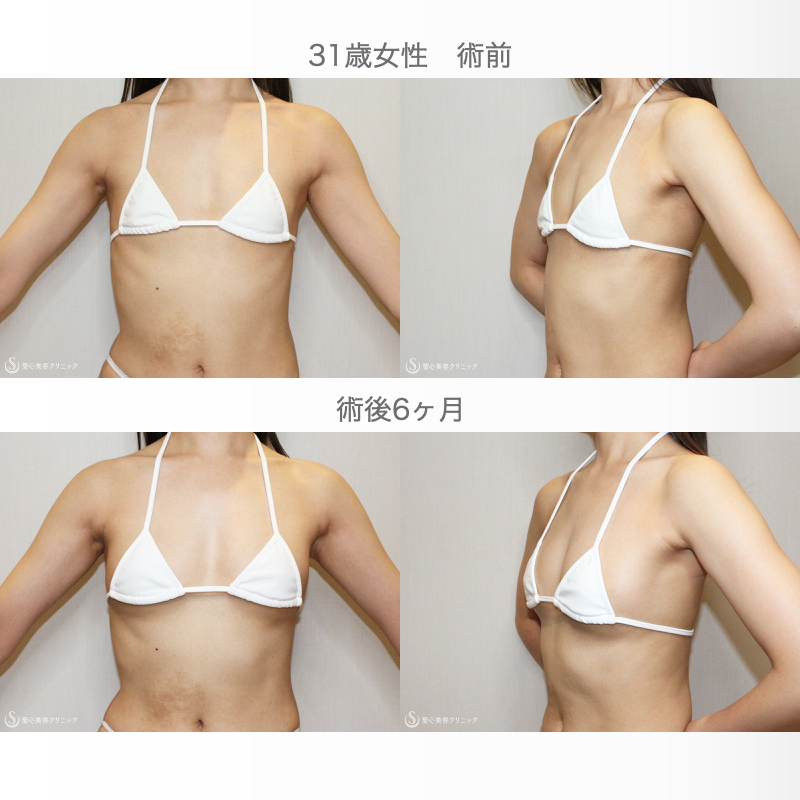 【31歳女性・脂肪幹細胞豊胸】プレミアムセリューション豊胸術（6ヶ月後） After 