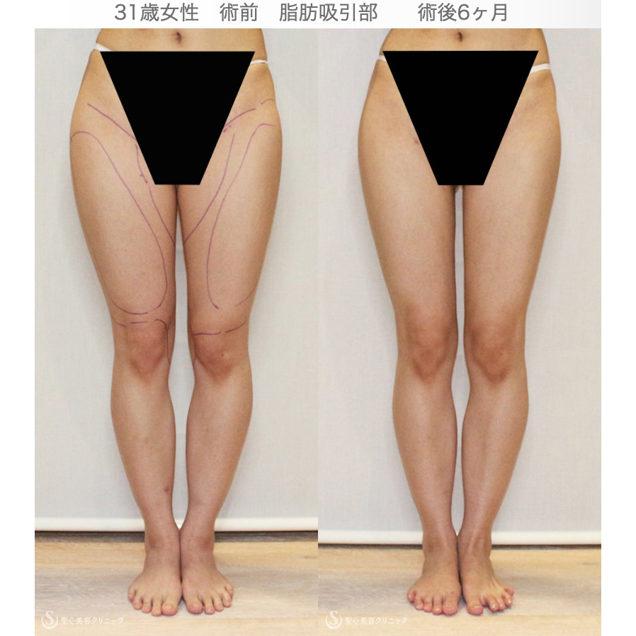 【31歳女性・脂肪幹細胞豊胸】プレミアムセリューション豊胸術（6ヶ月後） After 