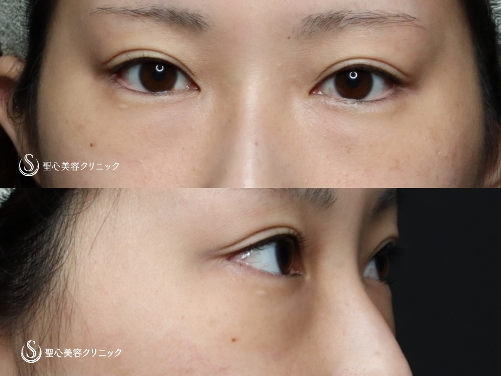 【20代女性・大きく可愛らしい目元に】たれ目形成（グラマラスライン／下眼瞼下制術）＋目の下の脂肪取り（経結膜下脱脂法）（9ヶ月後） Before 