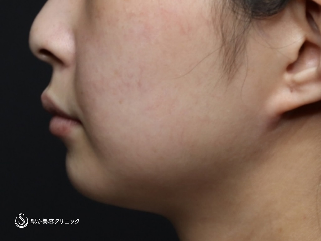 【20代女性・スッキリしたフェイスラインに】頬＋顎下ベイザーリポ2.2脂肪吸引（6ヶ月後） Before 