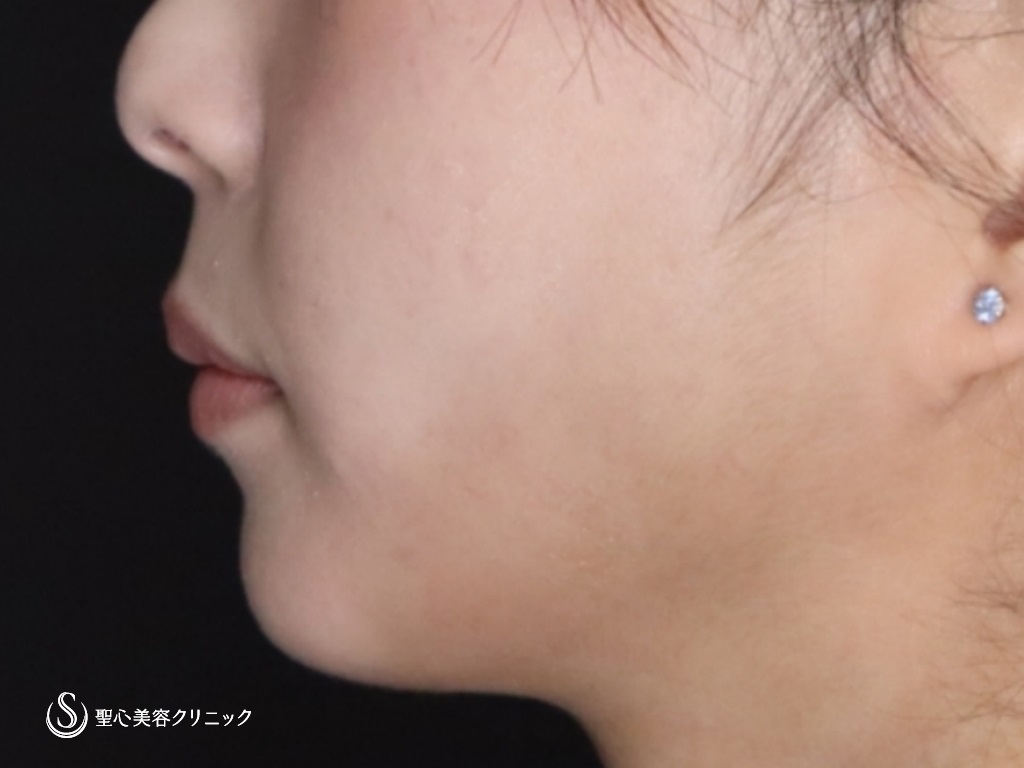 【20代女性・スッキリしたフェイスラインに】頬＋顎下ベイザーリポ2.2脂肪吸引（6ヶ月後） After 