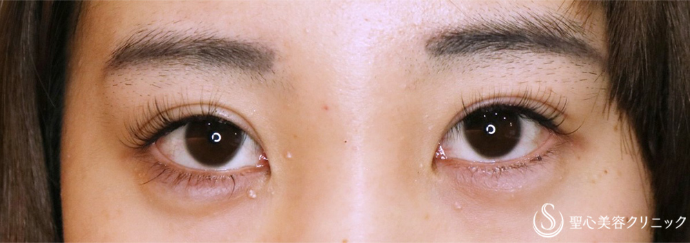 【20代女性・蒙古ひだ】目頭切開（術後5年） Before 