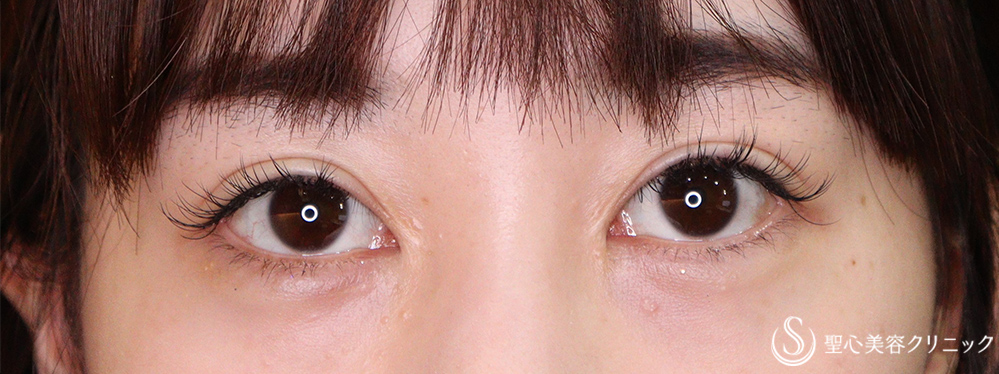 【20代女性・蒙古ひだ】目頭切開（術後5年） After 