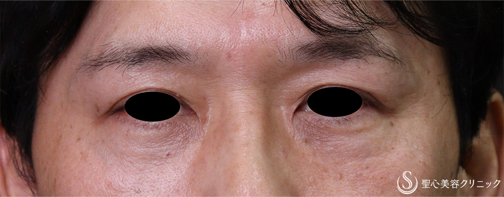 【40代男性・目の下のくま】目の下の脂肪取り（経結膜下脱脂法）、プレミアムPRP皮膚再生療法（術後2年） After 