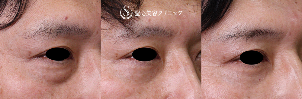 【40代男性・目の下のくま】目の下の脂肪取り（経結膜下脱脂法）、プレミアムPRP皮膚再生療法（術後2年） After 