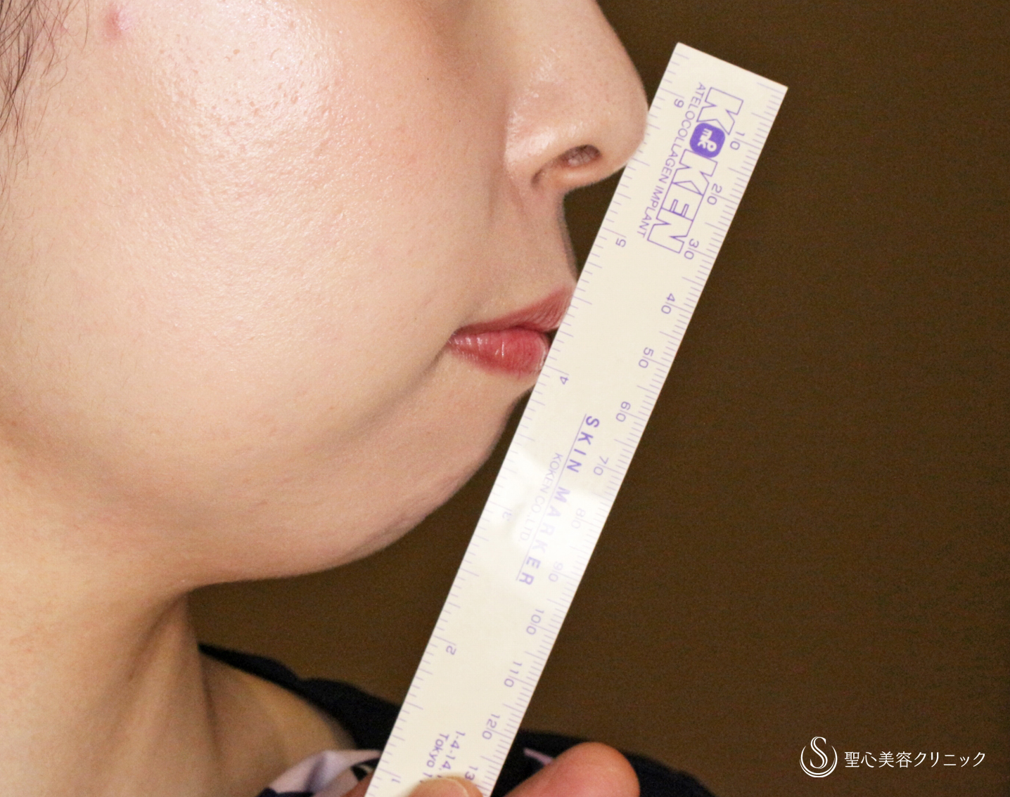 【20代女性・画期的なアゴの注入治療】ヒアルロン酸＆プレミアムPRP皮膚再生療法「ハイブリッド輪郭形成」（直後〜6ヶ月後） Before 