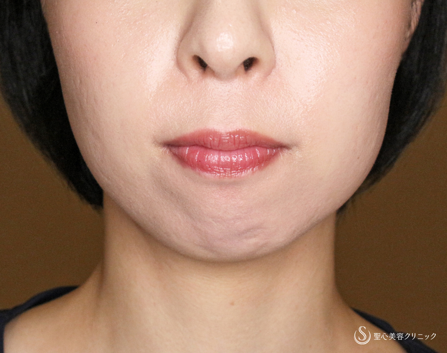 【20代女性・画期的なアゴの注入治療】ヒアルロン酸＆プレミアムPRP皮膚再生療法「ハイブリッド輪郭形成」（直後〜6ヶ月後） Before 
