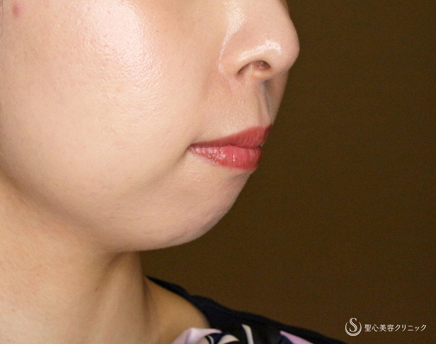 【20代女性・画期的なアゴの注入治療】ヒアルロン酸＆プレミアムPRP皮膚再生療法「ハイブリッド輪郭形成」（直後〜6ヶ月後） Before 