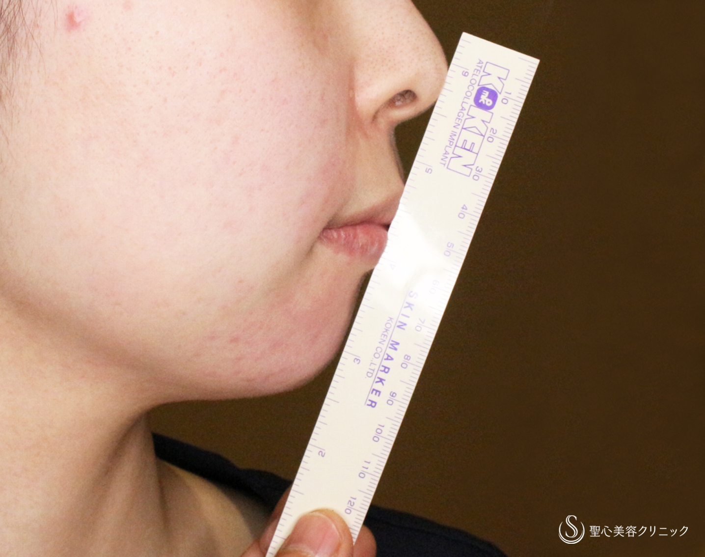 【20代女性・画期的なアゴの注入治療】ヒアルロン酸＆プレミアムPRP皮膚再生療法「ハイブリッド輪郭形成」（直後〜6ヶ月後） Before 