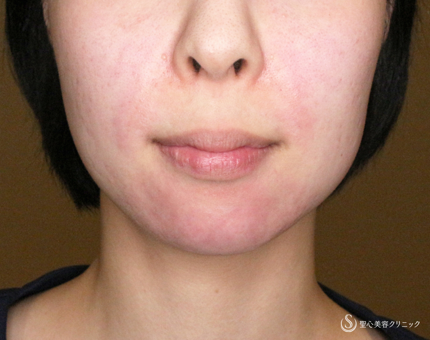 【20代女性・画期的なアゴの注入治療】ヒアルロン酸＆プレミアムPRP皮膚再生療法「ハイブリッド輪郭形成」（直後〜6ヶ月後） Before 