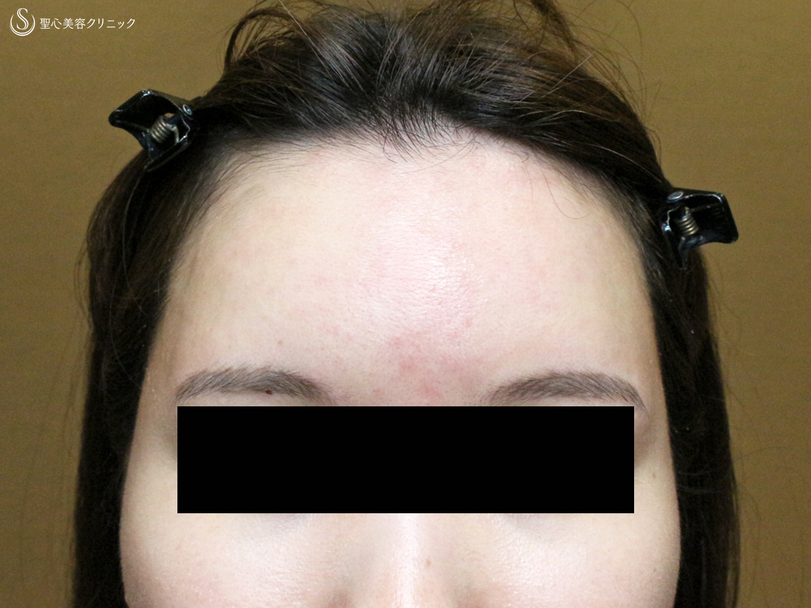 【30代女性・女性らしい丸いオデコをつくる】プレミアムPRP皮膚再生療法（直後〜6ヶ月後） Before 