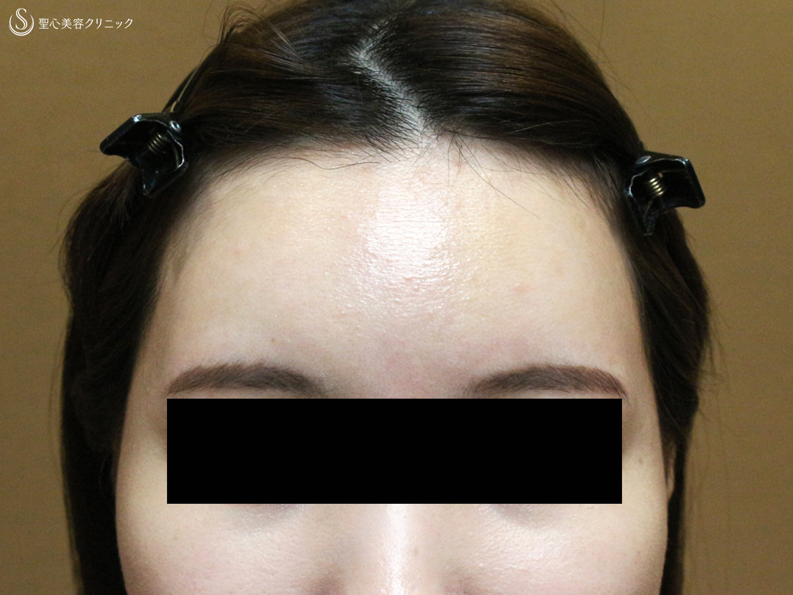 【30代女性・女性らしい丸いオデコをつくる】プレミアムPRP皮膚再生療法（直後〜6ヶ月後） After 