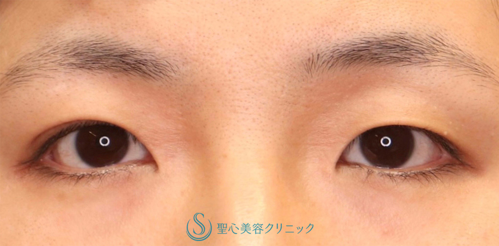 【30代女性・全切開法で綺麗な二重になりたい！！】二重術（全切開）（術後1ヶ月） Before 