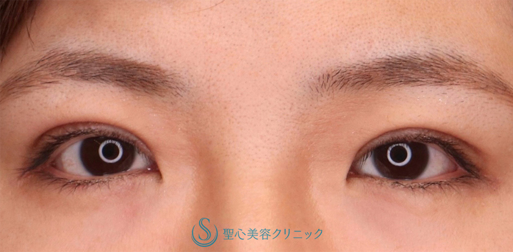 【30代女性・全切開法で綺麗な二重になりたい！！】二重術（全切開）（術後1ヶ月） After 