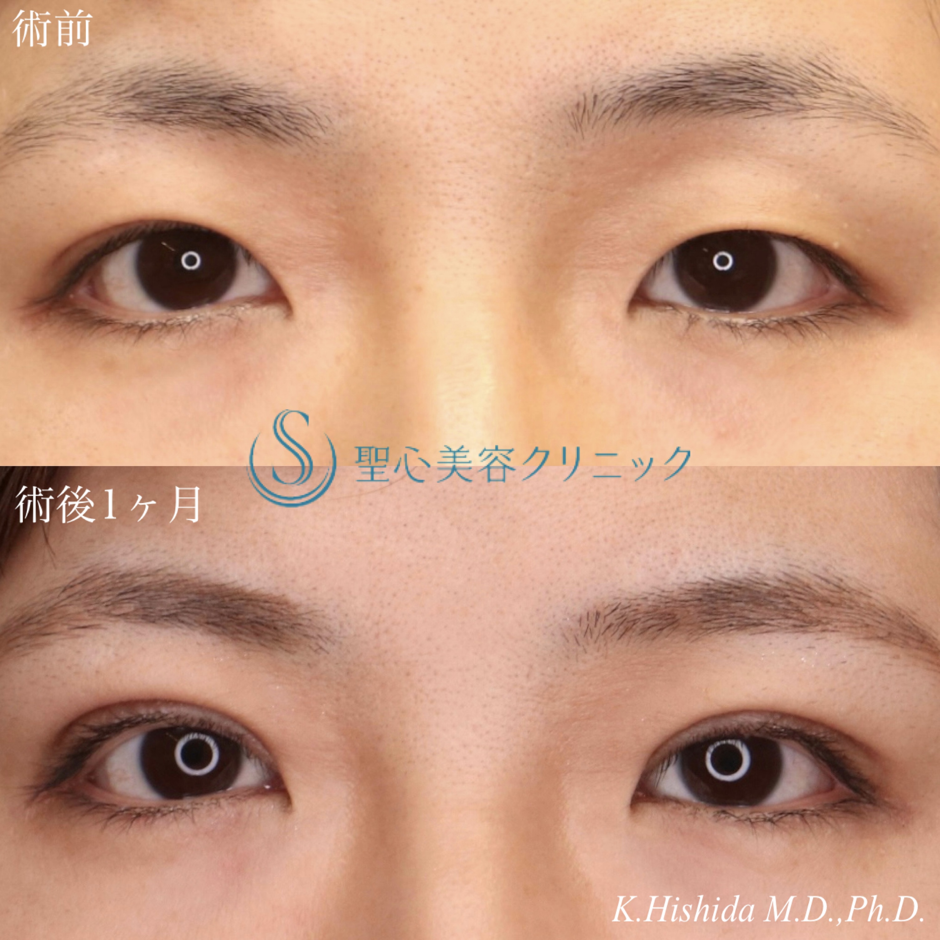 【30代女性・全切開法で綺麗な二重になりたい！！】二重術（全切開）（術後1ヶ月） After 